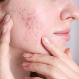 چگونه با طب سنتی جوش و آکنه را درمان کنیم؟